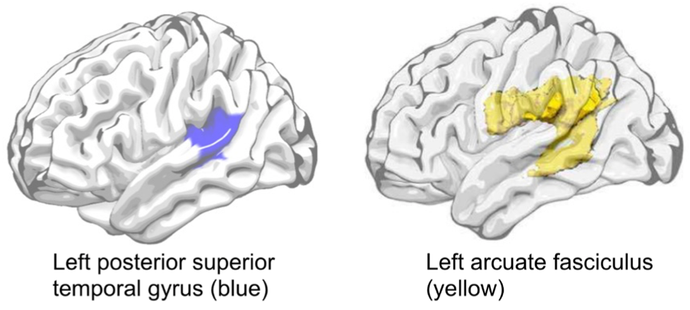 Predicting Aphasia Recovery: The Role of Brain Damage and SSRI Use